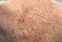 Kanada oo laga helay kiisas cusub oo busbus Daayeerada ah