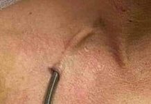 Howsha Dhaqidda ama Sifaynta Kelyaha (Dialysis)